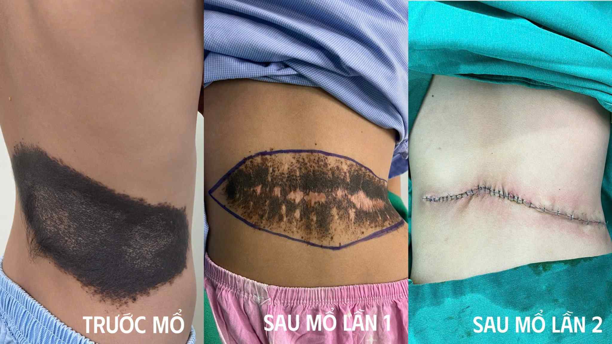 Tubers before and after surgery. Photo: Thanh Dang