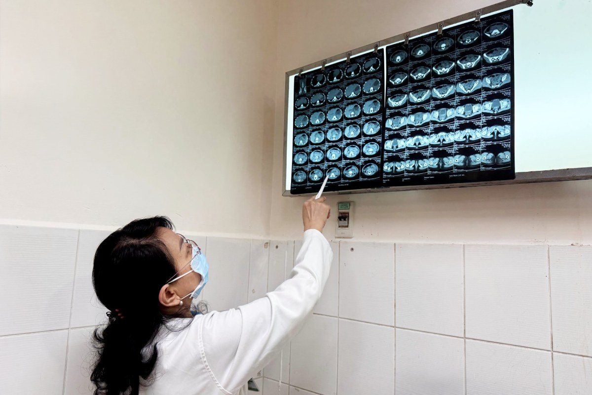 Bac si doc phim MSCT truoc va sau dieu tri cua benh nhi. Anh: BVCC