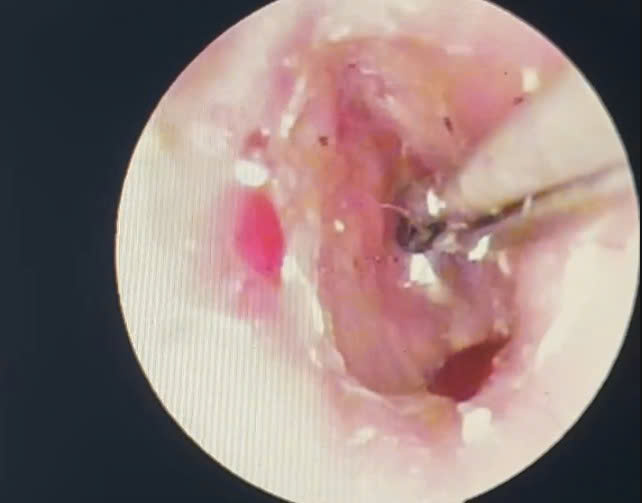 Dog scratches were removed from the ears of children in Quang Tri. Photo: Quang Ninh Regional General Hospital