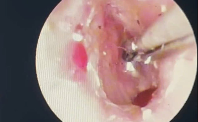 Dog scratches were removed from the ears of children in Quang Tri. Photo: Quang Ninh Regional General Hospital