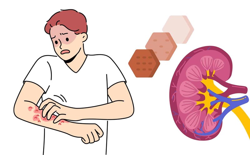 Some signs on the skin that signal kidney disease. Graphics: Ha May