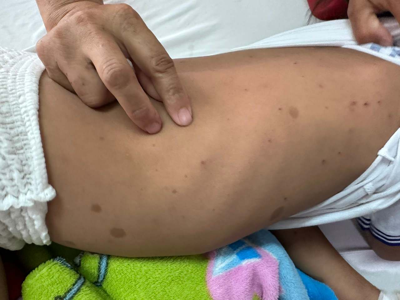 T.T.Sちゃんの体に ong dot による傷跡。写真:病院提供