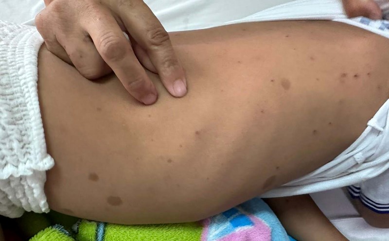 The wound caused by a bee stung on the body of T.T.S. Photo: Provided by the hospital