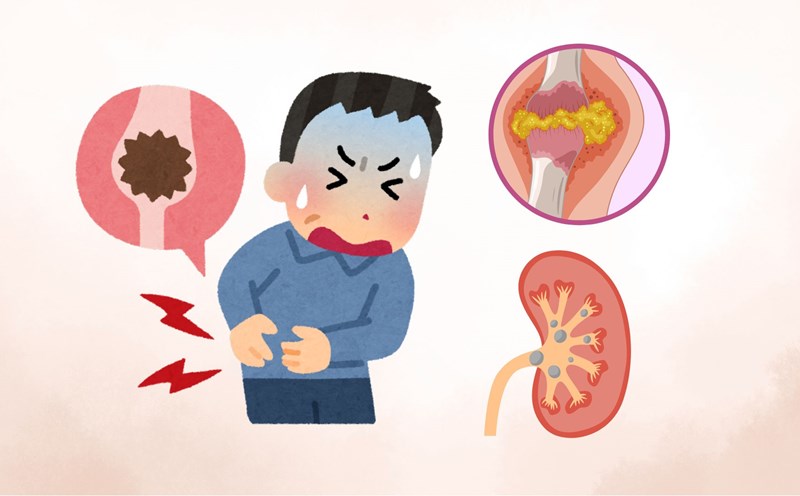 5 things to do to avoid uric acid accumulation, prevent gout and kidney stones. Graphics: Thanh Lam