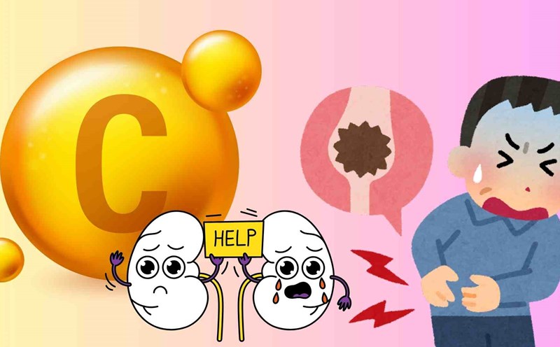 Vitamin C helps increase resistance and beautify the skin, but if supplemented incorrectly, you may face the risk of kidney stones. So what should be noted to take advantage of the benefits without harming your health? Graphics: Huyen Trang