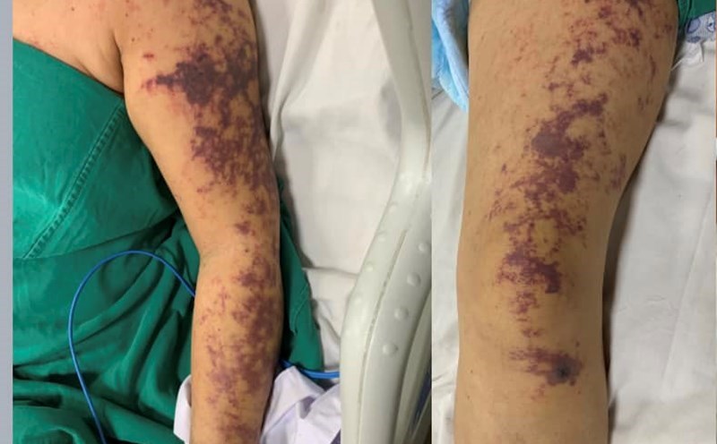 Symptoms of a patient with streptococcus purple. Photo: BVCC