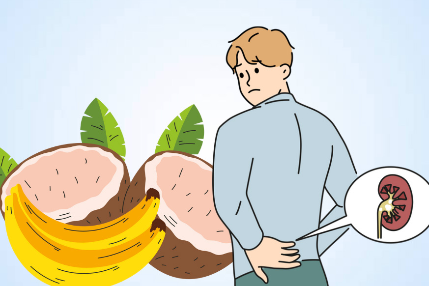 Risk of hyperkalemia when kidney patients eat coconut and banana at the same time. Graphics: Thien Nhan