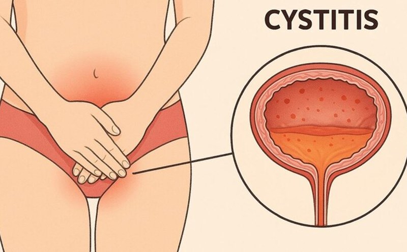 If treated incorrectly, bladder inflammation becomes a persistent obsession. Graphics: Huong Giang