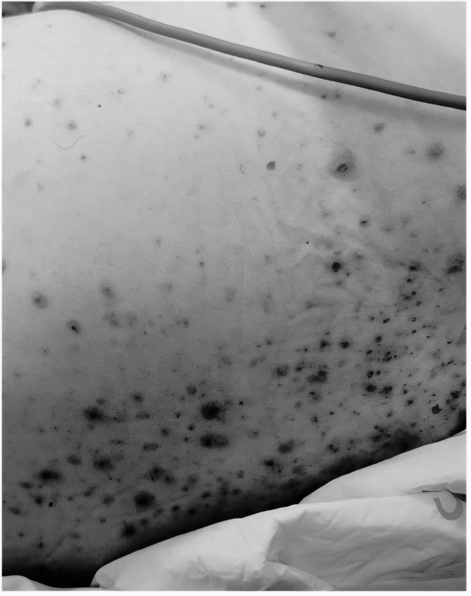 The chickpeas on the patient's body. Photo: Nguyen Ha