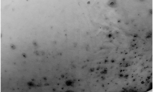 Những nốt thuỷ đậu trên cơ thể người bệnh. Ảnh: Nguyên Hà