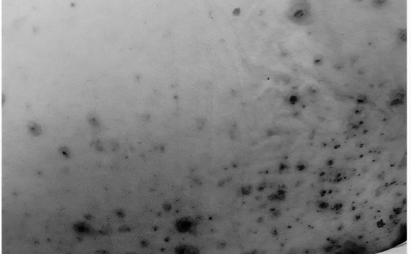 Las ojeras en el cuerpo del paciente. Foto: Nguyen Ha