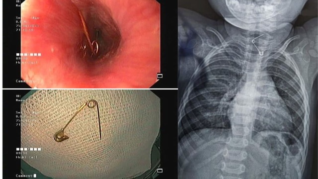 The child who swallowed the ice cubes had a sharp head stuck to the esophagus. Photo: Provided by the hospital