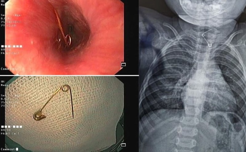 The child who swallowed the ice cubes had a sharp head stuck to the esophagus. Photo: Provided by the hospital