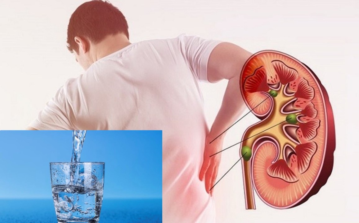 Drinking less water for a long time can also be a cause of kidney failure. Graphics: An An