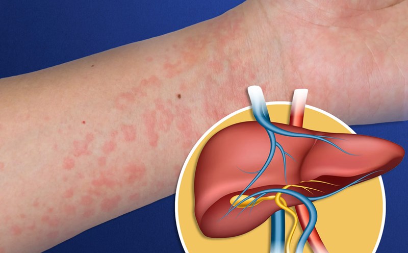 Many people mistakenly believe that the hives are due to impaired liver function, but this disease can actually be caused by many other reasons. Graphics: Vu Linh