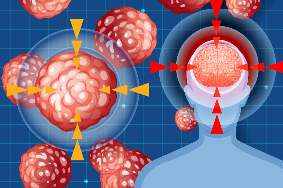 脳内で形成される血栓症の原因。グラフィック:ティエン・ニャン