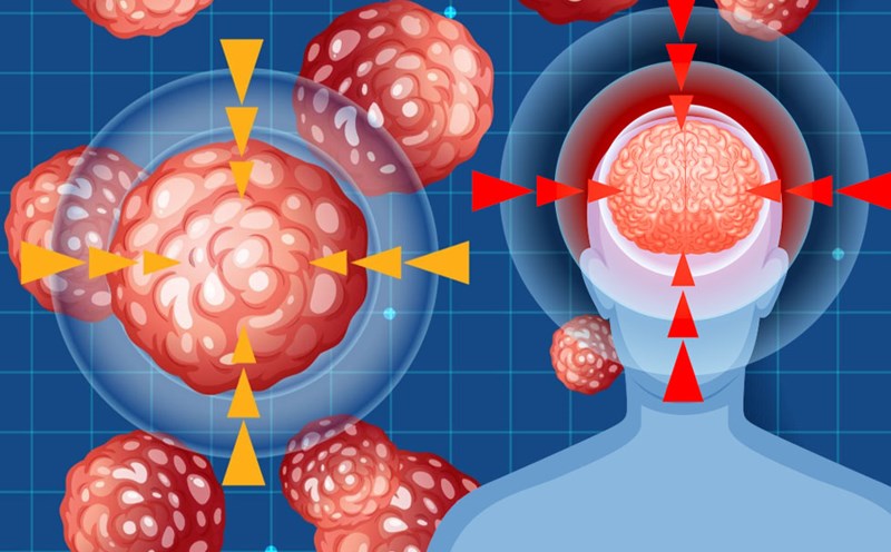 Causes of blood clots forming in the brain. Graphics: Thien Nhan