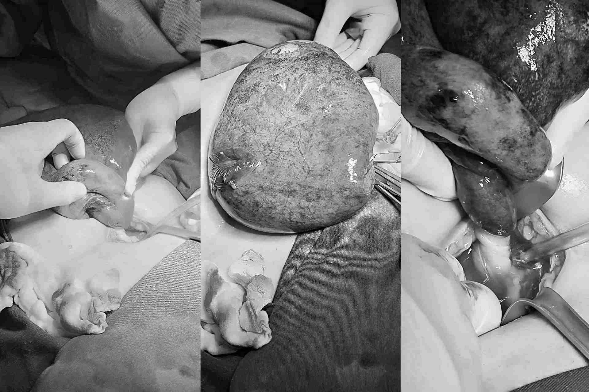 15세 환자의 몸에서 난소 종양이 제거되었습니다. 사진: BVCC