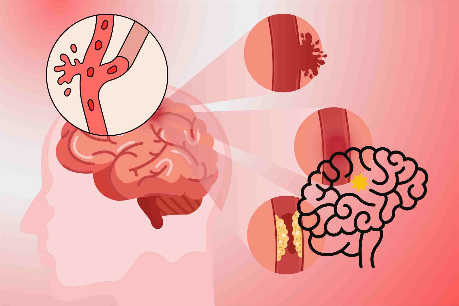 4 unusual warning signs of stroke that are easily overlooked