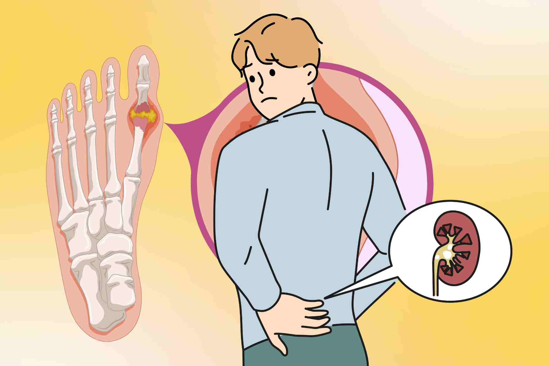 Special notes to prevent gout and kidney stones