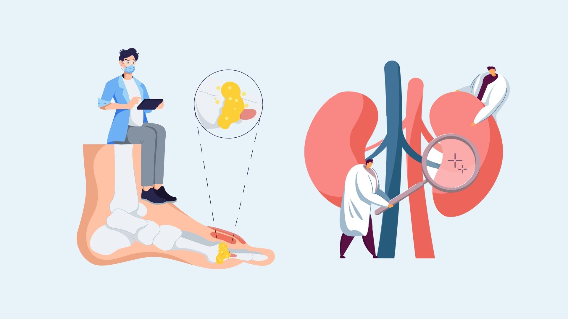 The potential danger of high uric acid that many people ignore. Graphics: Linh Dan