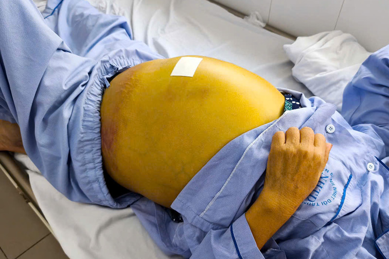 Subjective without regular check-ups, patients discover severely damaged liver