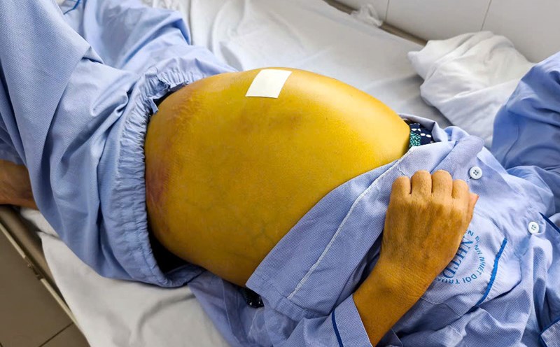 Subjective without regular check-ups, patients discover severely damaged liver