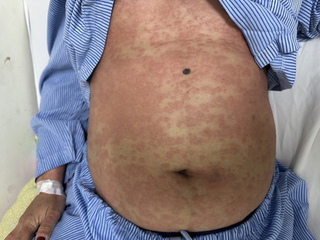 患者は、出所不明の腹部脂肪減少、コラーゲン製品を自己判断で使用した場合、重度のアレルギー反応を起こします。写真:病院提供