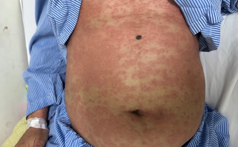 The patient had a severe allergic reaction when arbitrarily using belly fat reduction products and collagen of unknown origin. Photo: Provided by the hospital