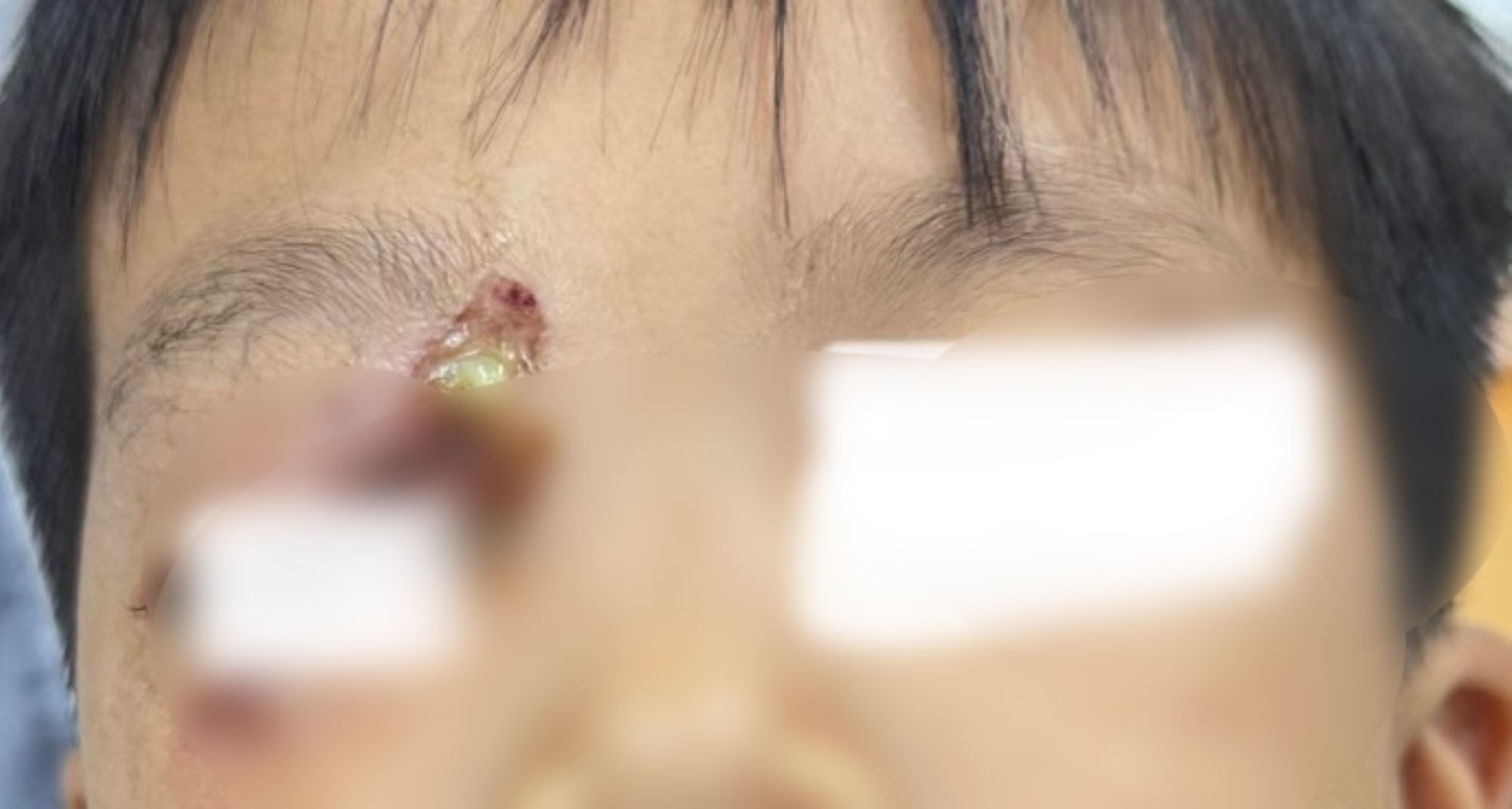 사고로 눈 부위를 다친 어린이. 사진: 병원 제공