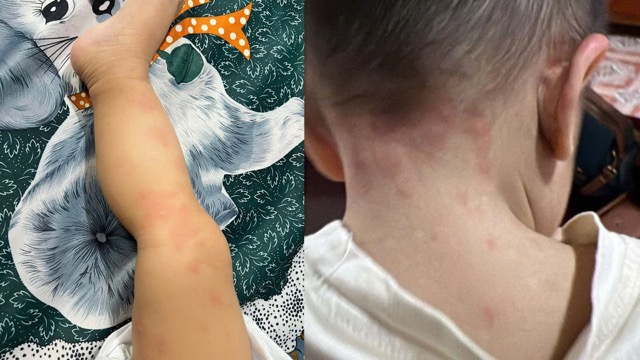 cow's milk allergy is easily confused with a common disease. Photo: Nguyen Ly