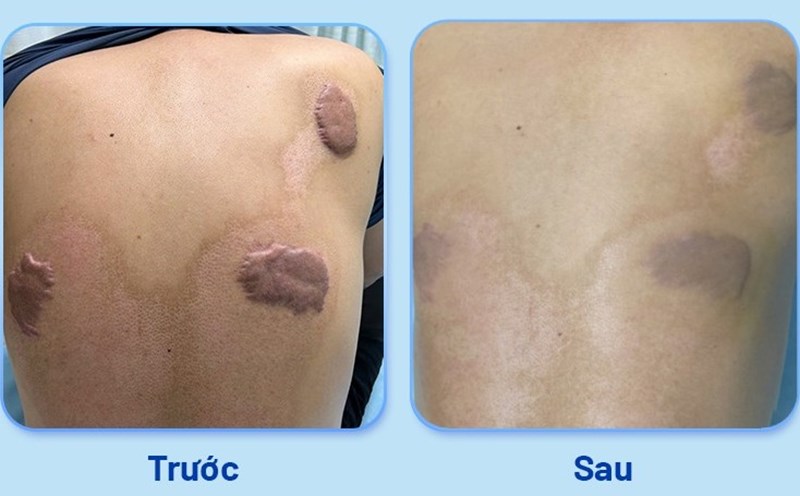 Sores in patients before and after treatment. Photo: Provided by the hospital