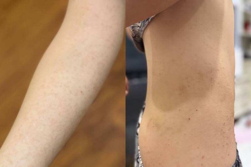 Con chị C.N.L bị mẩn ngứa sau khi tham gia trại hè. Ảnh: Phụ huynh cung cấp