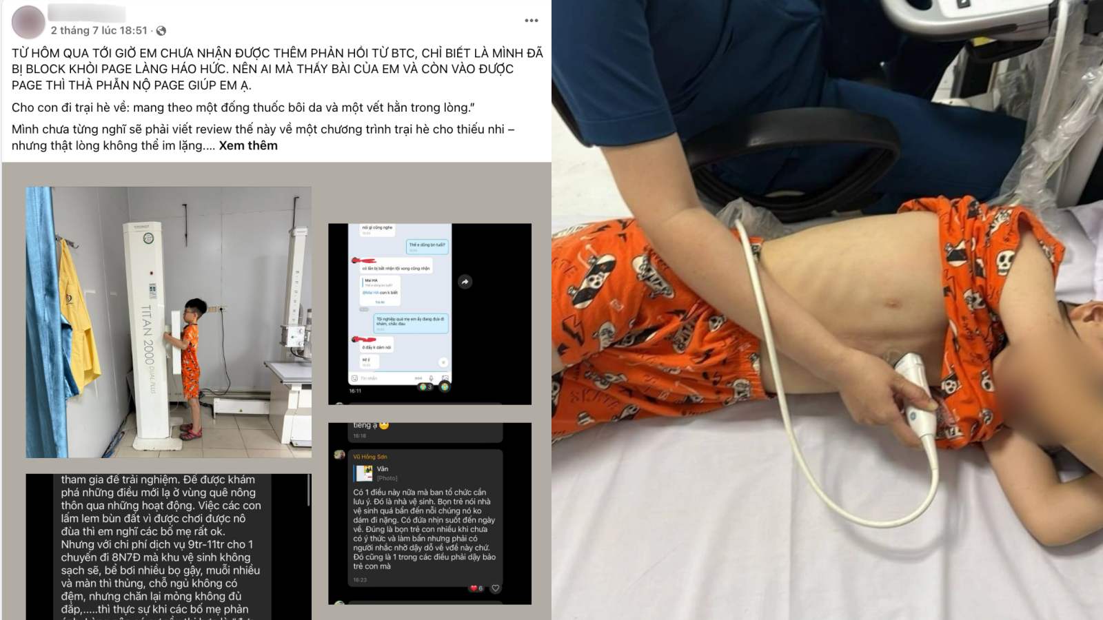 Chi C.N.L phan anh con trai bi bat nat, viem da nang sau khi ve tu trai he. Anh: Nhan vat cung cap