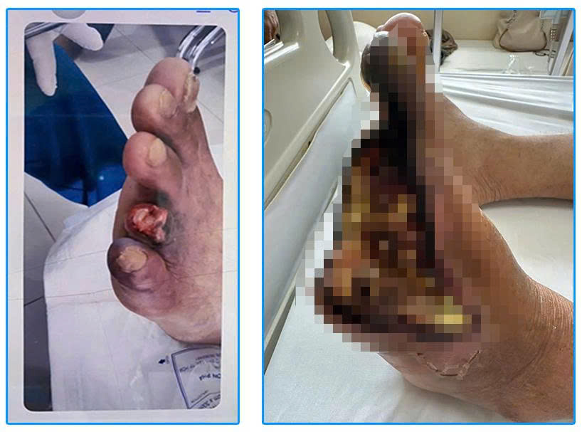 The patient's leg was ulcerated when he arrived at the hospital. Photo: Provided by City International Hospital