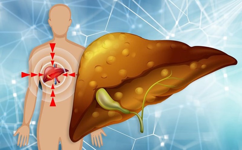 Warnings from the hands may show early signs of fatty liver disease. Graphics: Vu Linh