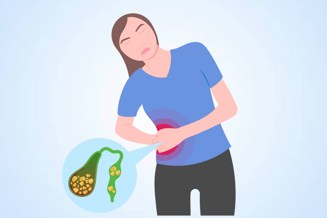 胆石は消化不良から始まる可能性があります。グラフィック:Thien Nhan