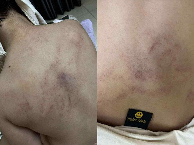 Phụ huynh ở Hà Nội tố bé gái 4 tuổi bị giáo viên mầm non đánh đập, kéo lê, ném vào tường