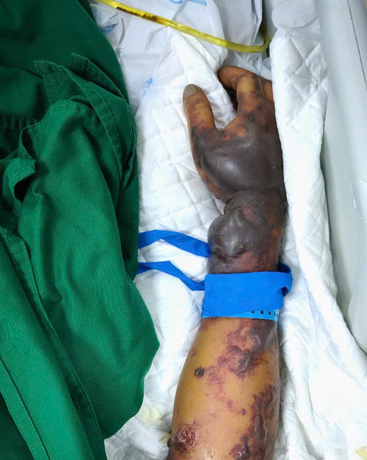 The patient's body had bruises after eating the pork intestines and intestines. Photo: Thanh Dang