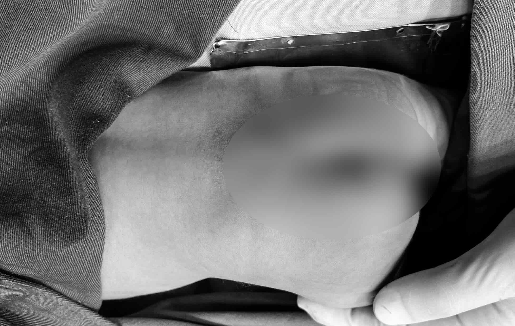 A 2-day-old baby underwent surgery for a rare bone marrow herniation. Photo: Vietnam - Cuba Dong Hoi Friendship Hospital