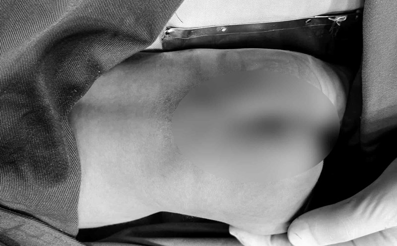 A 2-day-old baby underwent surgery for a rare bone marrow herniation. Photo: Vietnam - Cuba Dong Hoi Friendship Hospital