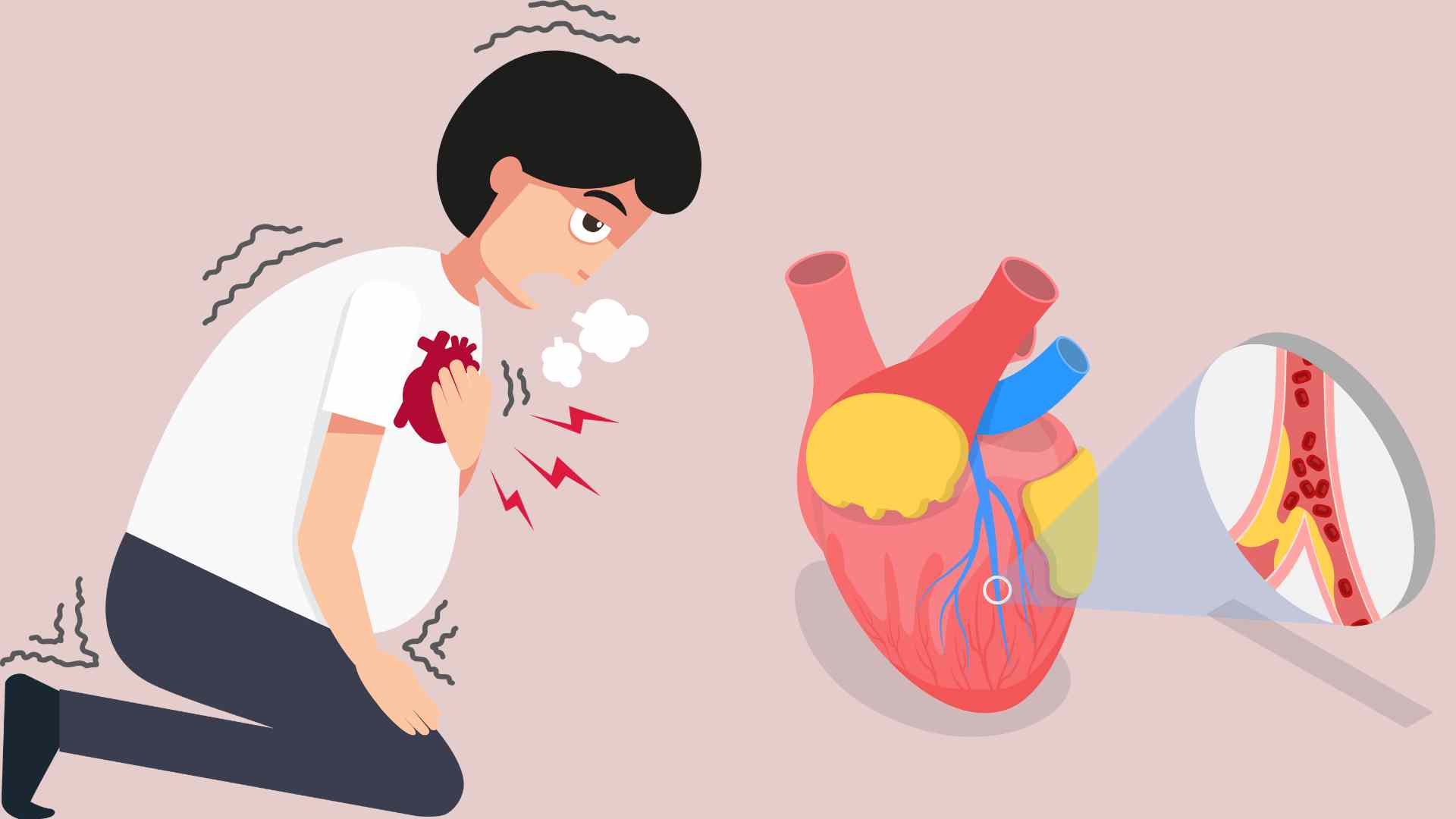 Symptoms of myocardial infarction. Graphic photo: Thai Anh
