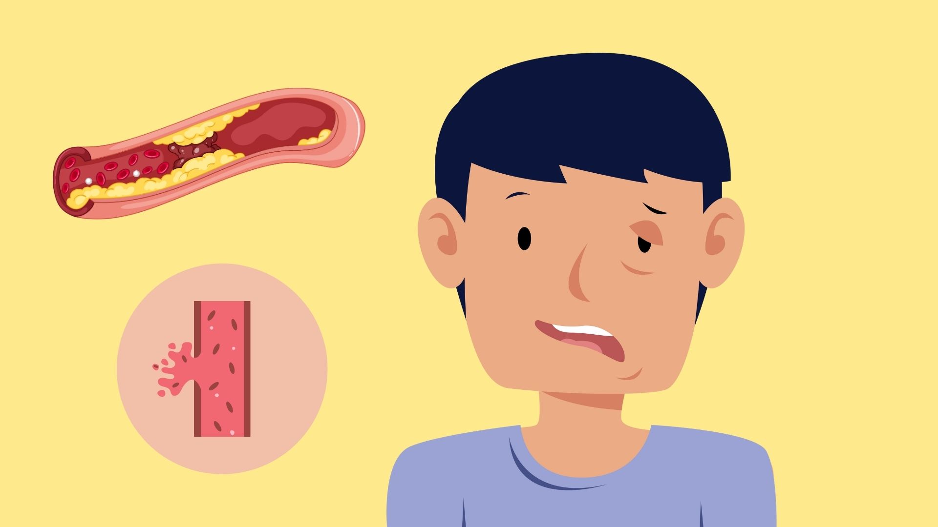 Il est necessaire de construire un mode de vie sain pour eviter le risque d'accident vasculaire cerebral. Photo graphique : Minh Hoang