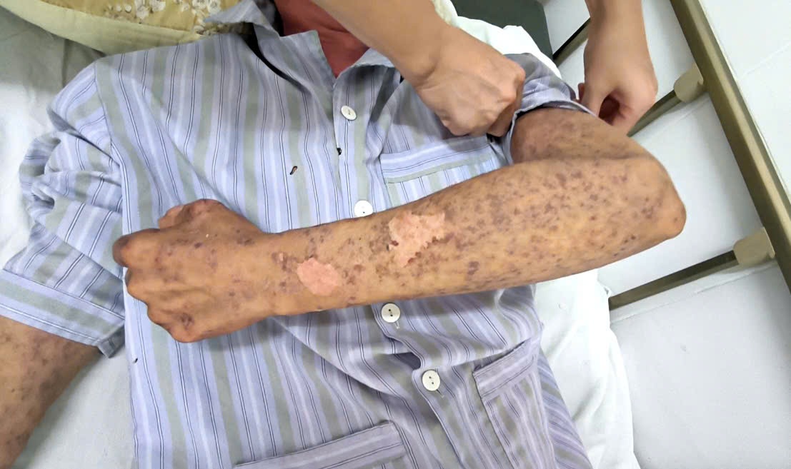 The man suffered burns all over his body and was temporarily blind due to leprosy-proof silicone. Photo: Thanh Dang