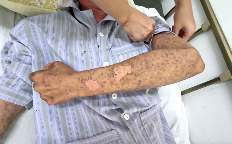 The man suffered burns all over his body and was temporarily blind due to leprosy-proof silicone. Photo: Thanh Dang