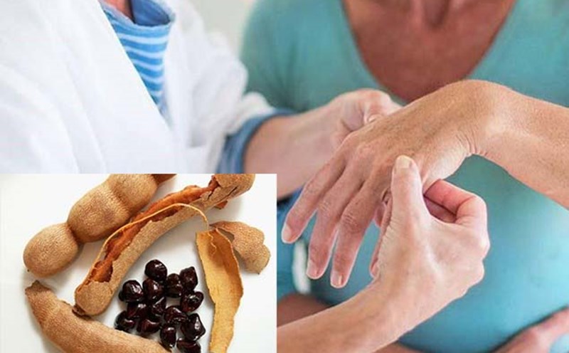 The truth about the trend of using tamarind seeds to treat arthritis. Graphics: Cat Tien
