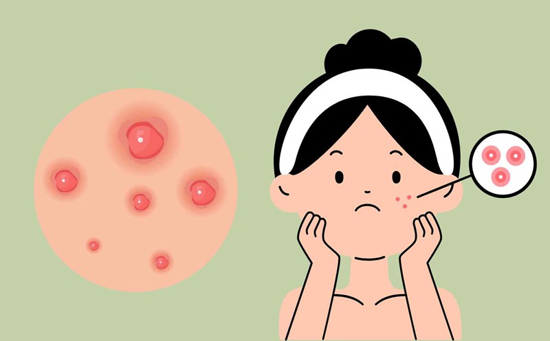 Acne is a obsession for many women. Graphic photo: Hoang Loc