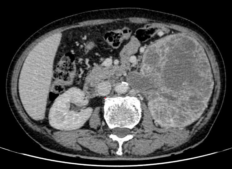 CT scan of the kidney tumor encroaching on the inferior varicose vein. Photo: BVCC