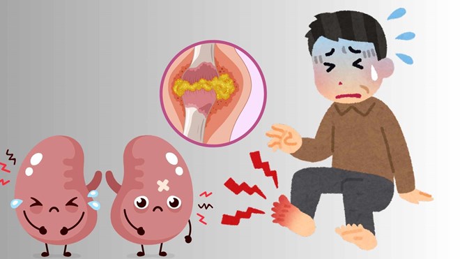 Gout patients need to control their diet and avoid foods rich in purines. Graphics: Ha May