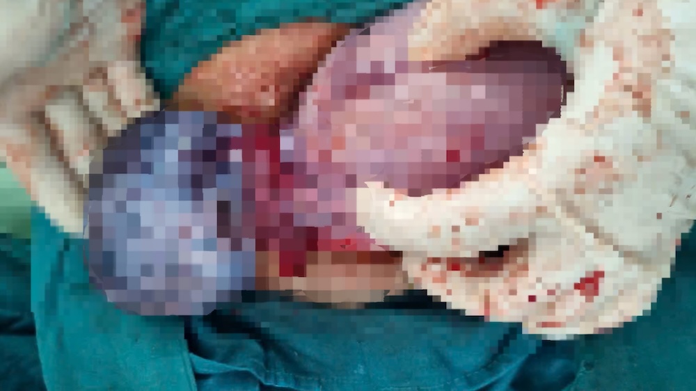 Image of the baby born with a returned cyst that was destroying his mother in Quang Tri. Photo: Quang Ninh Regional General Hospital